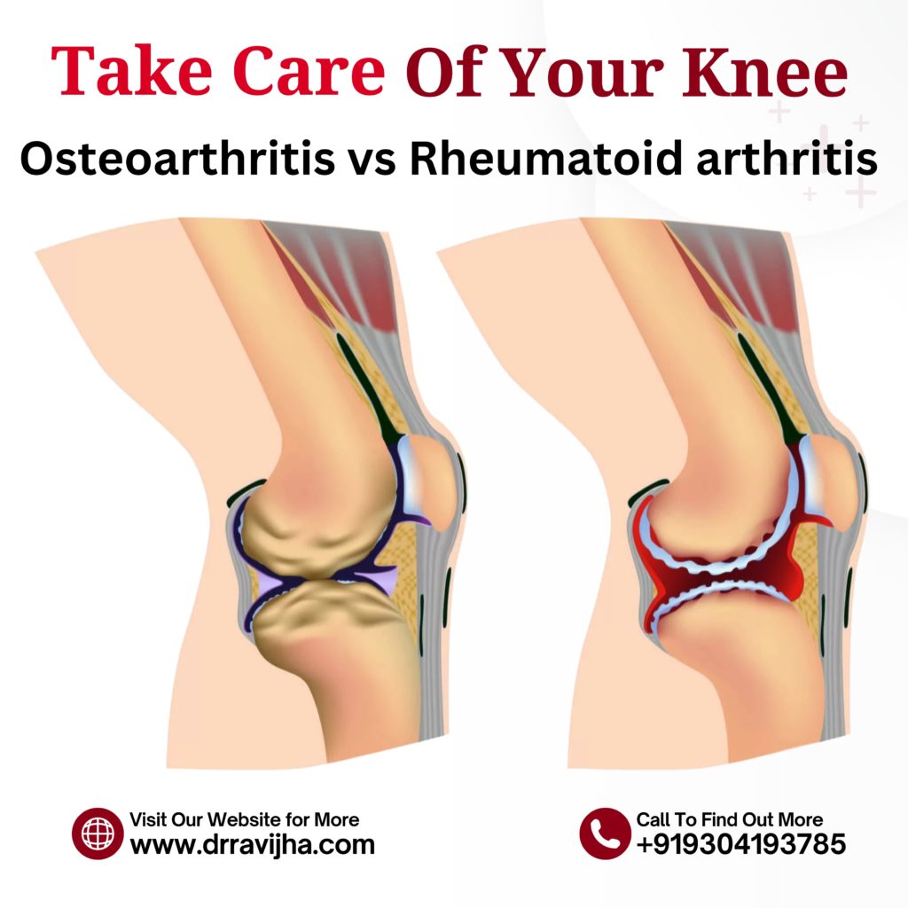 Osteoarthritis vs. Rheumatoid Arthritis: Key Differences